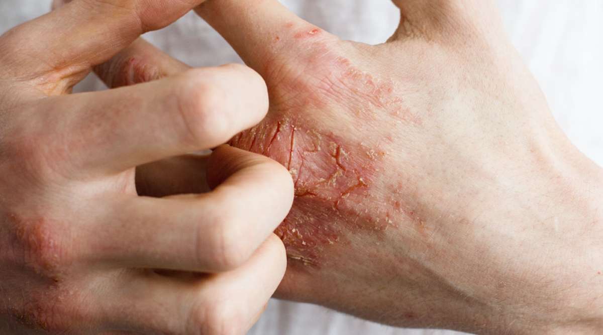 Bei der Psoriasis vulgaris oder Schuppenflechte leiden die Patienten unter Schuppungen und Rötungen