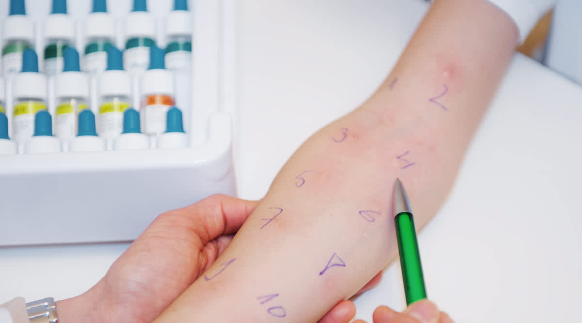 Um die Auslöser der allergischen Reaktion zu ermitteln, kommen verschiedene Testverfahren wie der Pricktest zum Einsatz
