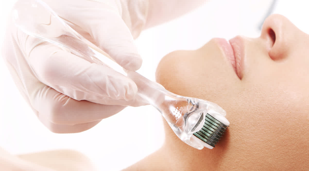 Microneedling
